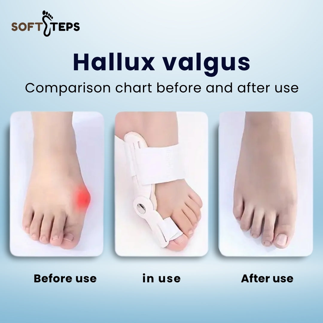 SoftSteps Bunion Toe Shaper