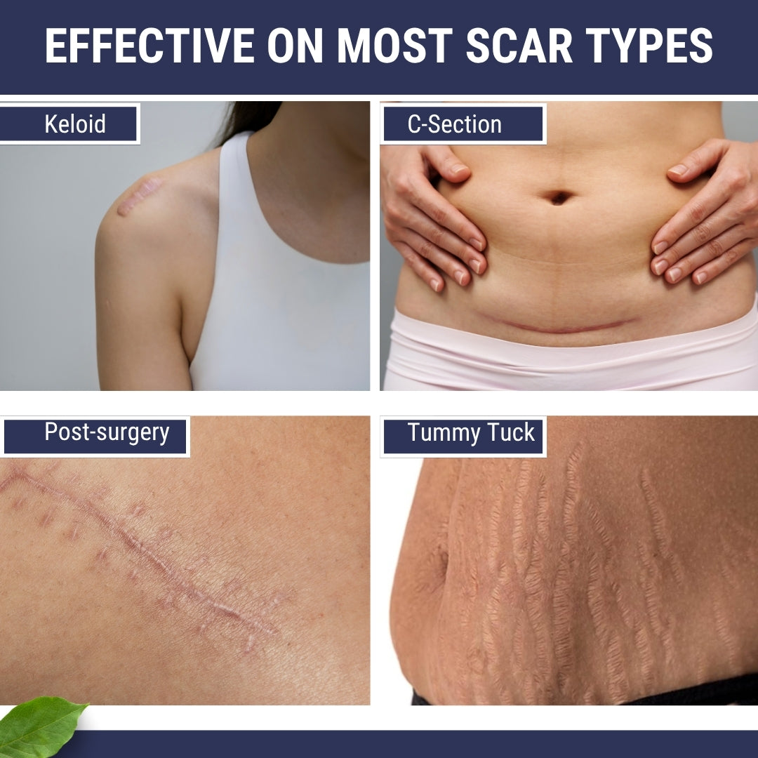 Scar Free Skin Tape - Soft on skin, tough on scars