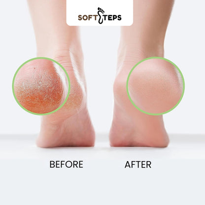 Tea Tree Oil Foot Soak with Epsom Salt